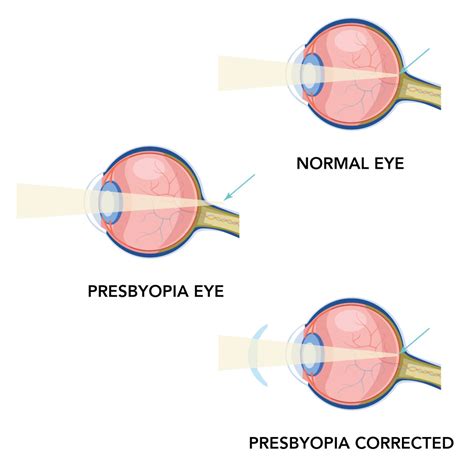 Presbyopia treatment west springs calgary  Pilocarpine HCl ophthalmic solution 1